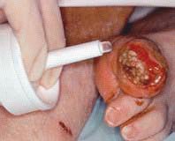 Hydrogel Wound Dressing Intrasite 0.52 oz. Gel / Amorphous NonSterile