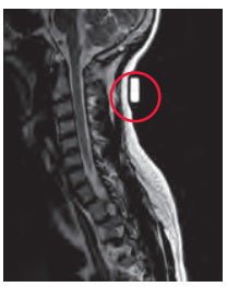 Radiology Skin Marker MRI Spee-D-Mark™ Oblong General Use