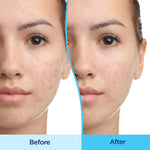 Differin Gel Acne Treatment