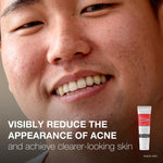 Neutrogena® Rapid Clear Stubborn Acne Spot 10% Benzoyl Peroxide Gel, 1 ounce