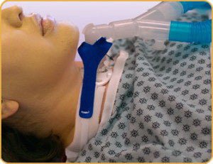 Vent Circuit Anti-Disconnect Device For Trach Ties® Tracheostomy Tube
