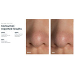 KIWI™ Blackhead Remover Pore Vaccum